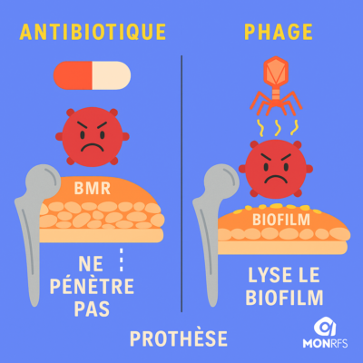 Schéma expliquant la différence entre l’action d’un antibiotique et d’un phage sur une infection de prothèse avec biofilm
